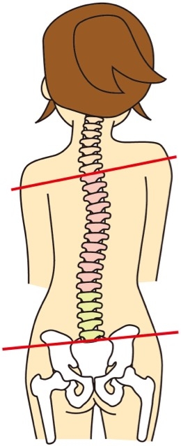 沖縄 腰痛 側弯 日常の癖1