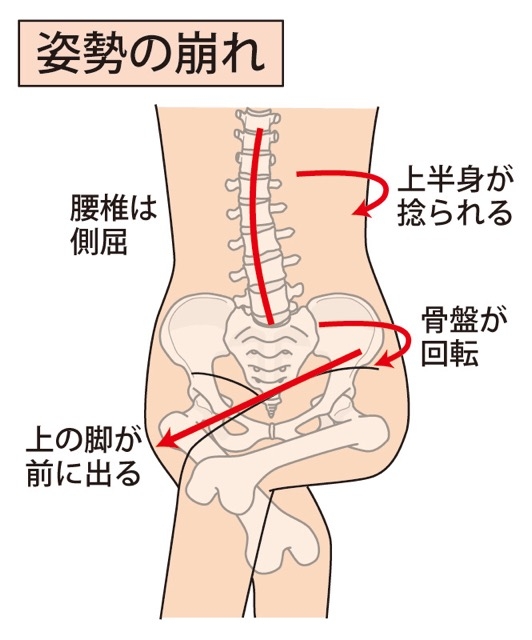 沖縄　腰痛　側弯症　生活の癖